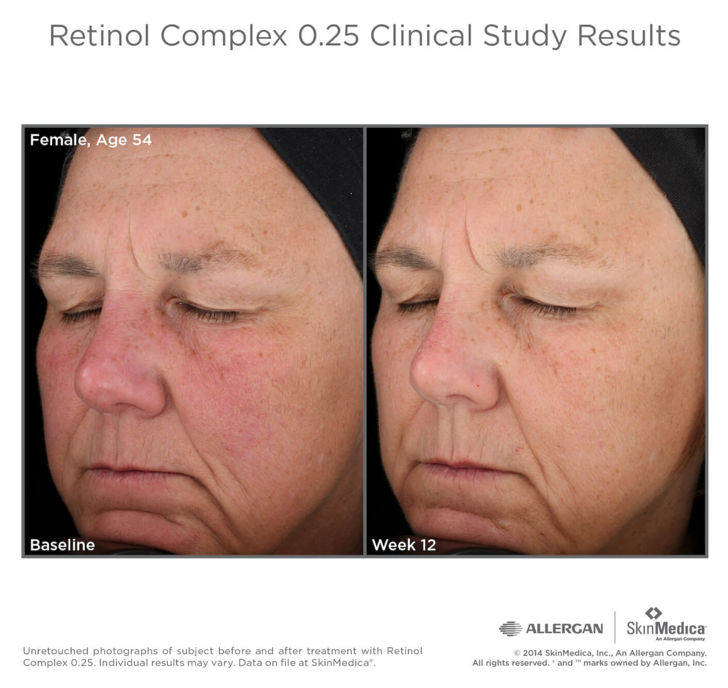 Retinol Complex 1, 0.5 or 0.25 by SkinMedica®