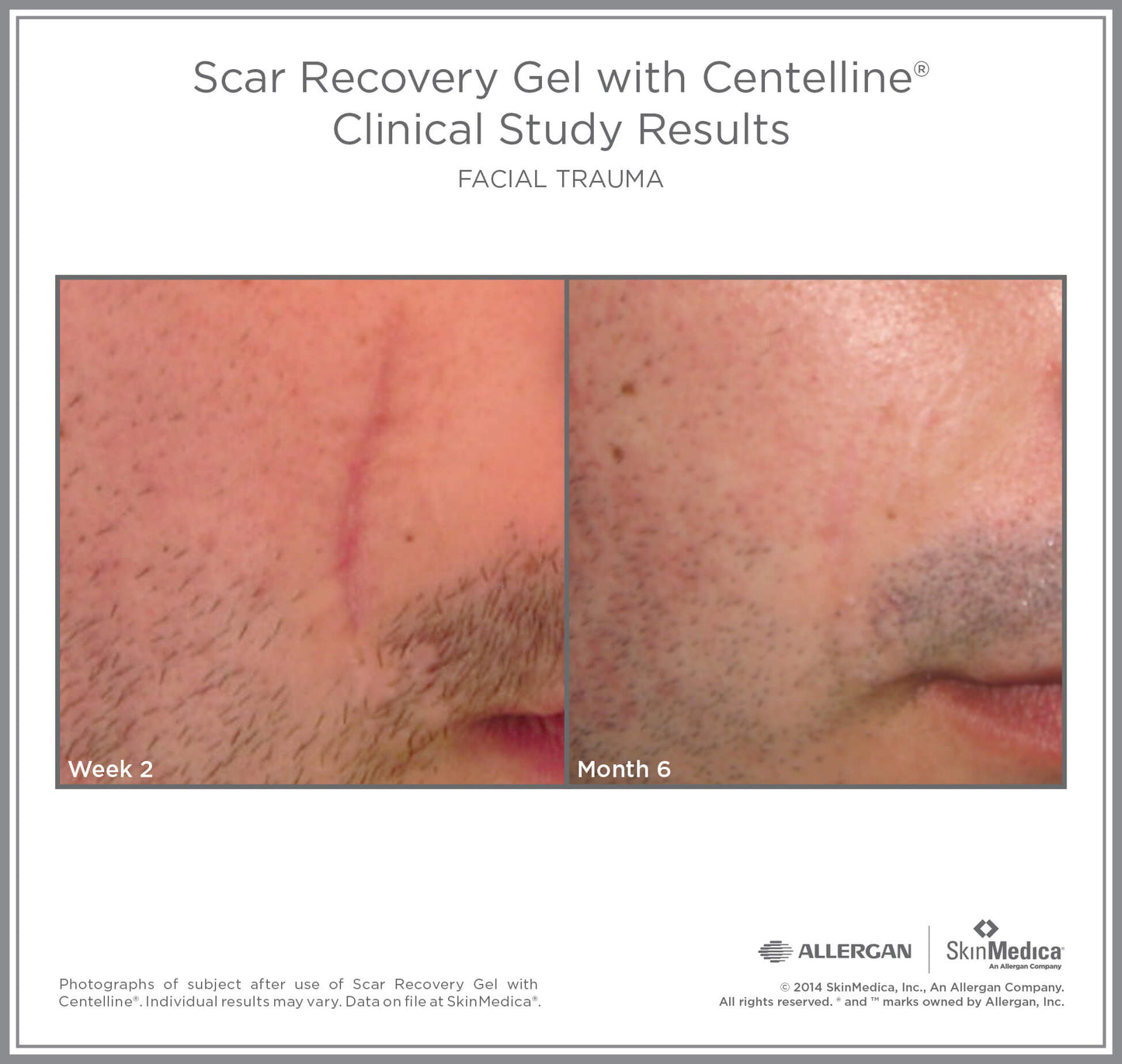 Scar Recovery Gel with Centelline® by SkinMedica®